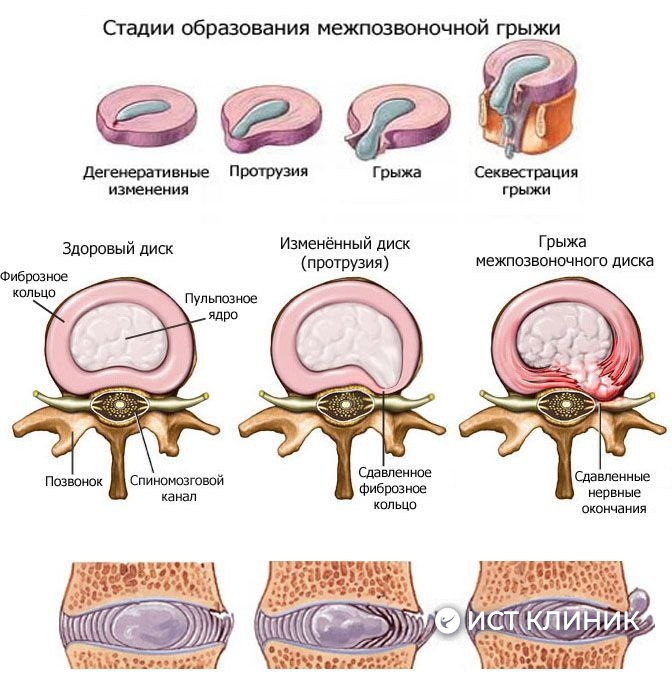 Нейропатия (полинейропатия) нижних, верхних конечностей: симптомы, лечение