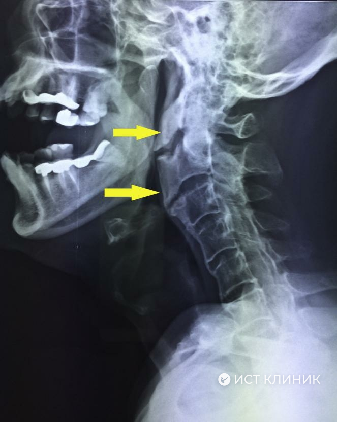 Болезнь Форестье - шейный отдел позвоночника