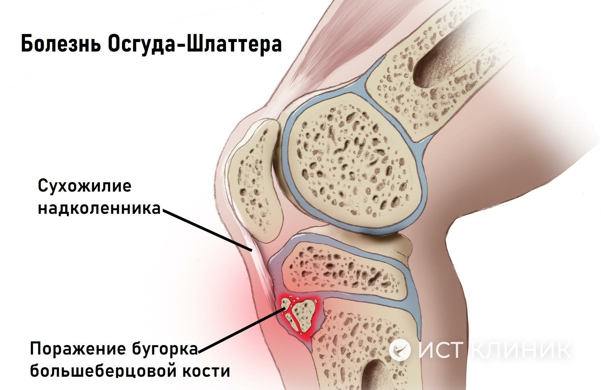 Лечение болезни Осгуд-Шлаттера в Ист Клиник