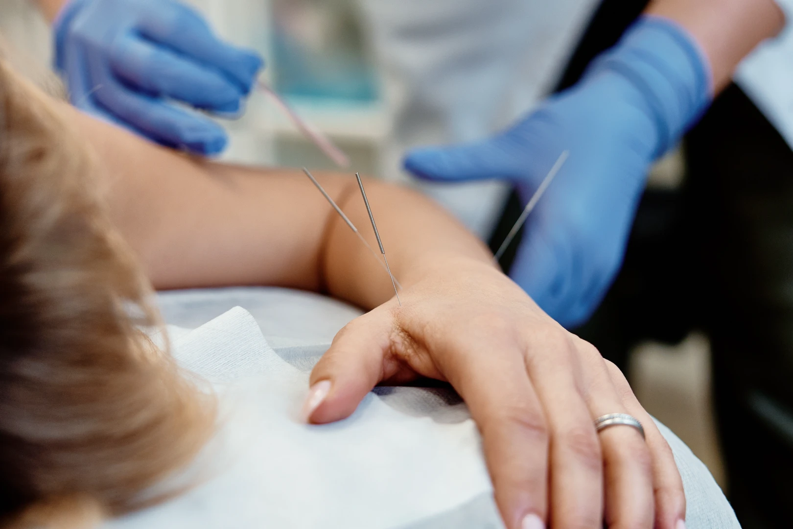 Врач проводит иглотерапию пациенту
